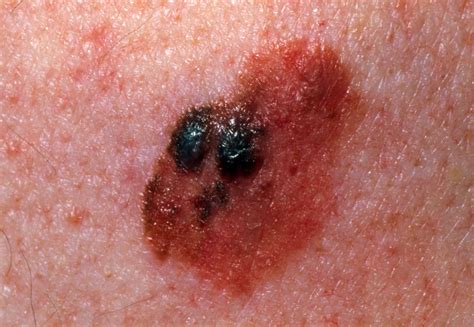 spot  differences   mole  skin cancer
