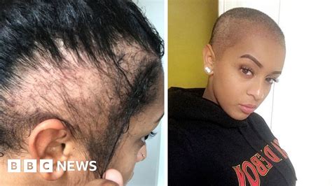i had a transplant after my hairstyle made me go bald bbc news