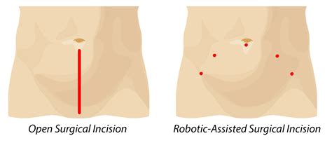 Robotic Prostatectomy Surgery