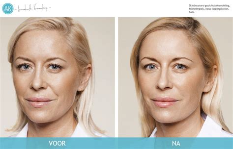 voor en na fotos cosmetische behandelingen annebeth kroeskop