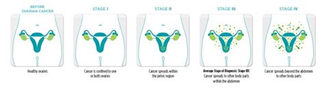 background research ste sos pbl ovarian cancer 2016