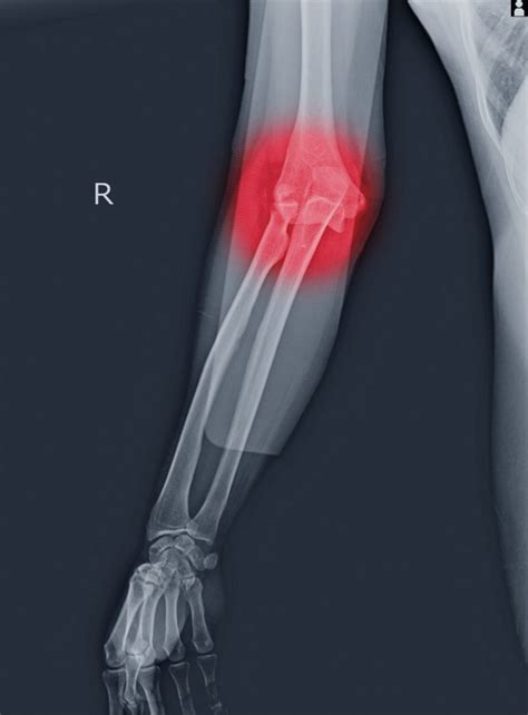 treat elbow fractures central florida bone joint institute