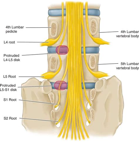 left neural foramen stenosis artofit