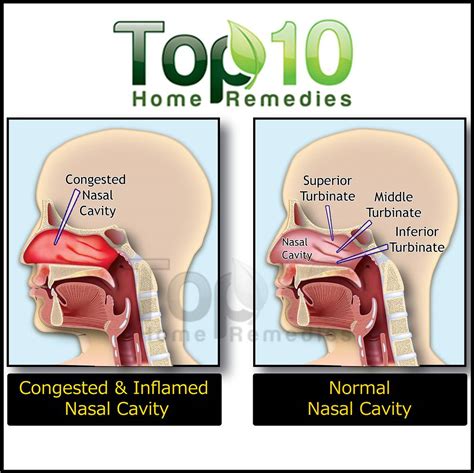 home remedies  nasal congestion top  home remedies