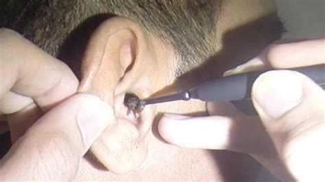 man s massive ear wax extraction youtube