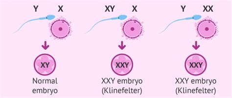Klinefelter Syndrome Xxy Syndrome Symptoms Causes And Fertility