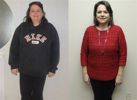 Debra S Weight Loss Transformation St Louis Bariatrics