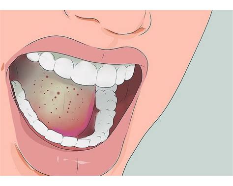 hongos en la boca candidiasis causas y síntomas