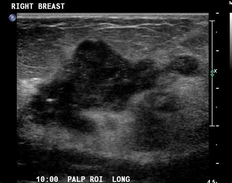 chinese drywall inflammatory breast cancer porno archive