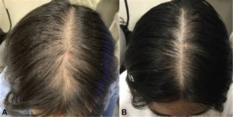 spironolactone  treatment  female pattern hair loss journal   american academy
