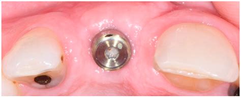 dentistry journal  full text  simplified technique  implant