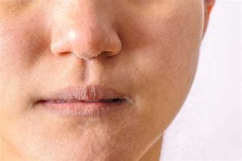 Eczema On The Lips Types Triggers Causes And Treatment