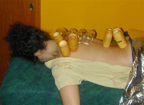 cupping alternative medicine and healing without medications feel