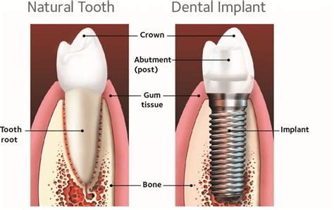 dental implants  manchester  serenity dental spa