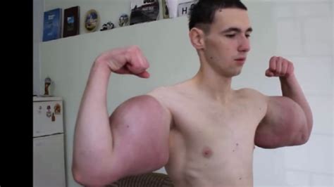 synthol infection