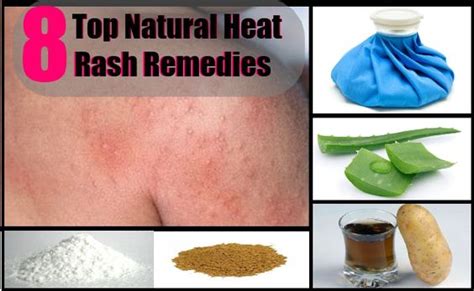 heat rash remedies  natural  pinterest
