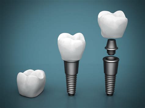 implant wallpapers top  implant backgrounds wallpaperaccess