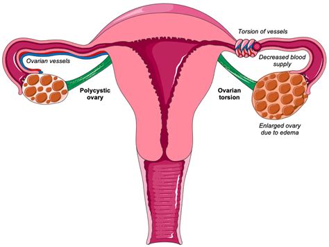 biomedicines  full text ovarian torsion  polycystic ovary syndrome  potential threat