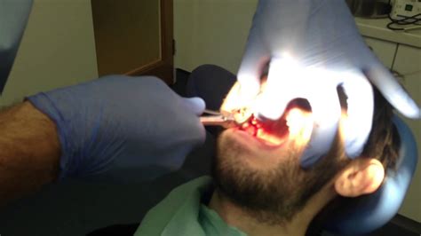 tooth  pulled   dentist  graphic sfw youtube