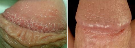 Pearly Penile Papules Nyc 212 644 6454 Nyc Pearly Penile Papules
