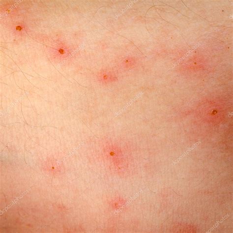 allergic rash dermatitis eczema skin stock photo  cpanxunbin