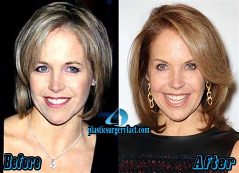 katie couric plastic surgery before and after plastic surgery facts