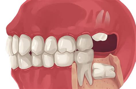 what you should know about an impacted wisdom tooth symptoms sure dental