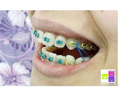 How To Pick The Best Teal Braces For Your Teeth Braces Explained
