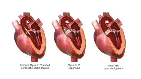 Tavr A Powerful Ally In The Battle Against Aortic Valve Stenosis