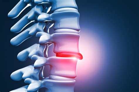 herniated disc specialist palm harbor fl orthopedic specialists