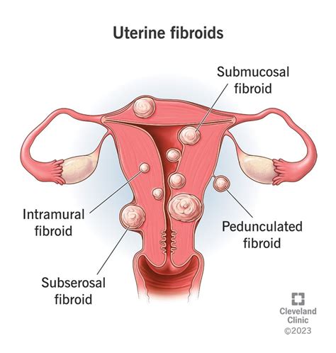 Uterine Fibroids Causes Symptoms And Treatment