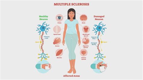 multiple sclerosis symptoms  ultimate