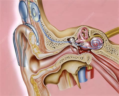 cochlear implant artwork stock image  science photo library