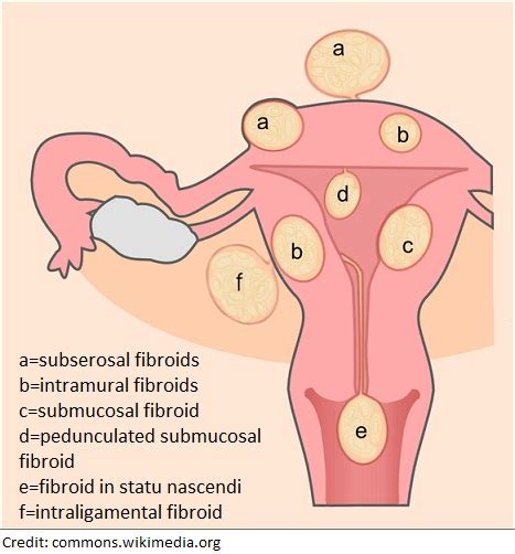 The One Fibroid Myth You Keep Falling For