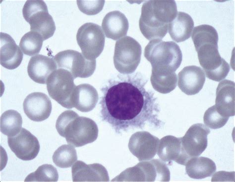 phenotypic characteristics of hairy cell leukaemia hairy hot photos