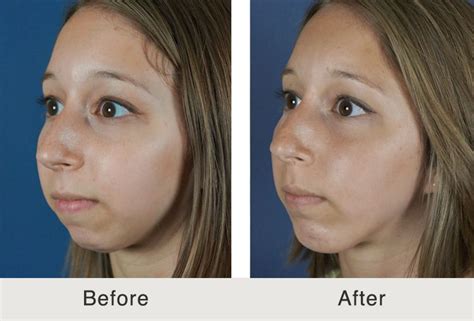 chin implant carolina facial plastic surgery carolina