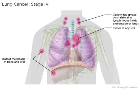 Lung Most Cancers Stage Four Metastasis To Mind