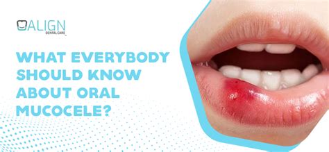 oral mucocele oral mucous cysts