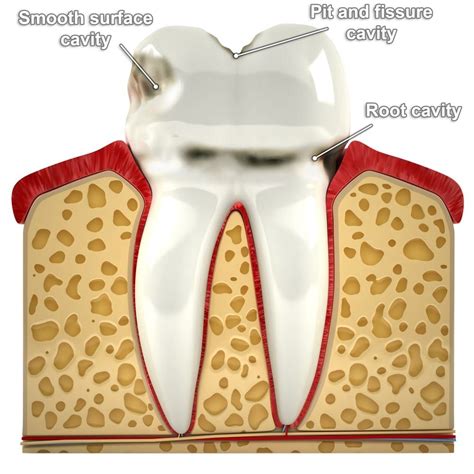 cavities  ultimate guide quarterpath dental