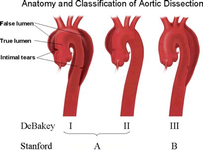 aortic dissection aortic dissection vascular surgery dissection