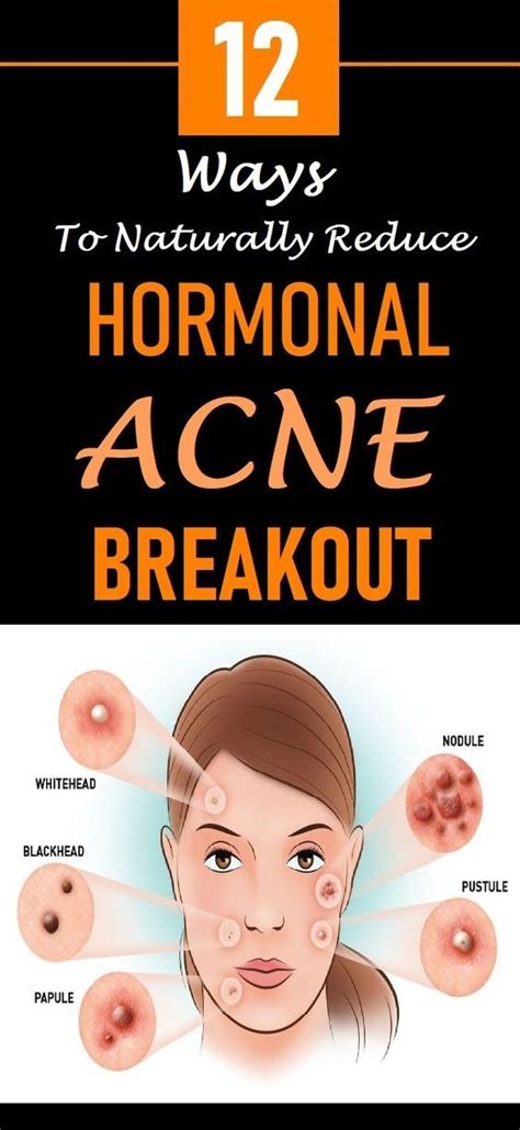 12 Ways To Naturally Reduce Hormonal Acne Breakout
