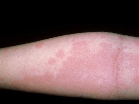 long   food allergy rash    baby   allergic