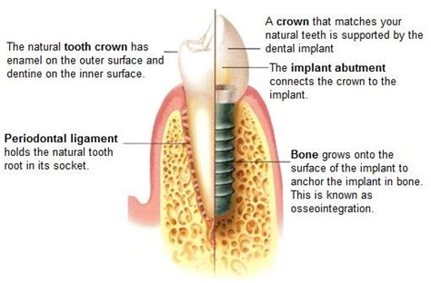 dental implant treatment perio melbourne