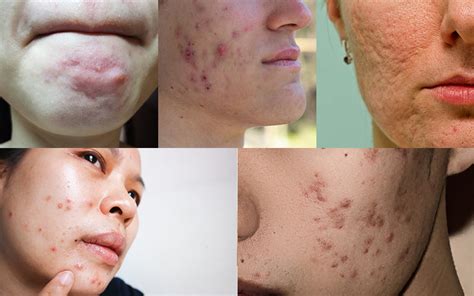 Why Is Popping Pimples Bad For Your Skin – Reequil