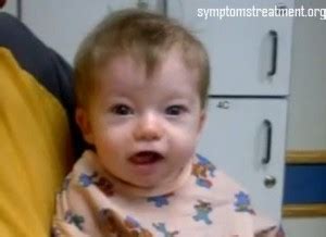 digeorge syndrome pictures syndrome treatment