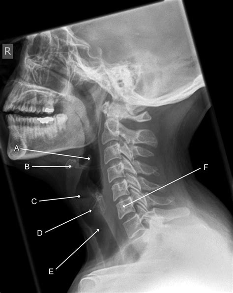 radiograph showing  soft tissues   neck lateral view  bmj
