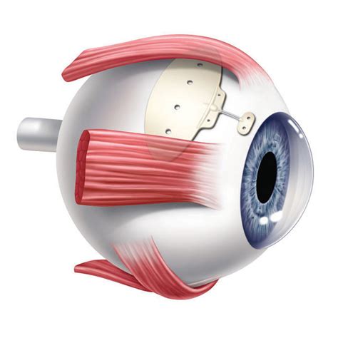 baerveldt tube ahmed valve kersley eye clinic london