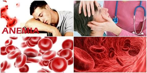 Anemia Microcitica Hipocromica Síntomas Causas