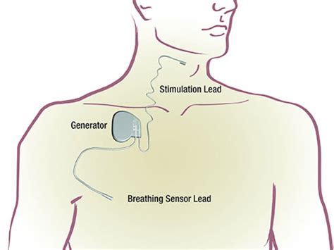 implantable device   uab eases sleep apnea news uab
