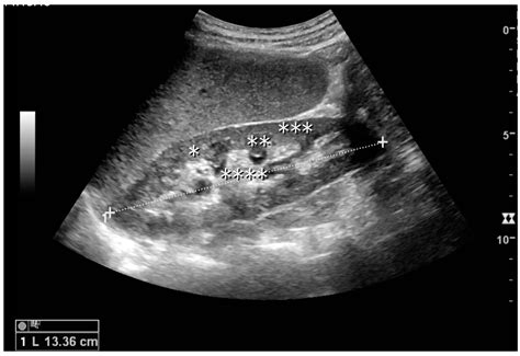 kidney ultrasound